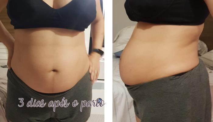 kinesio taping pós parto